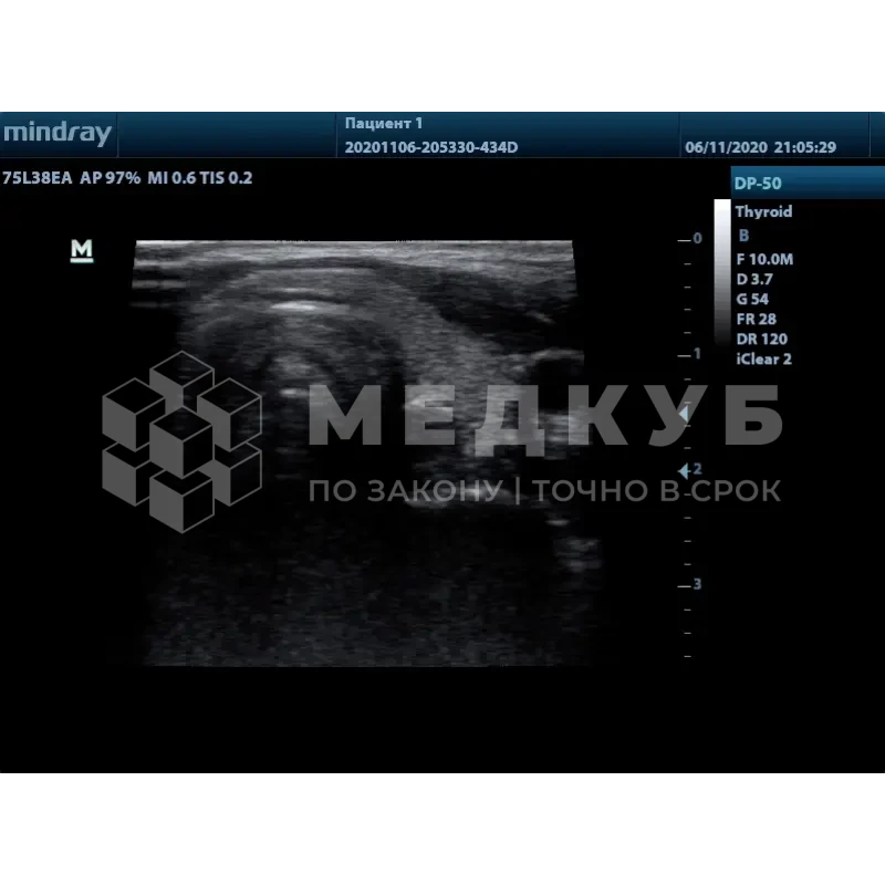 Аппарат УЗИ (сканер) Mindray DP-50 color