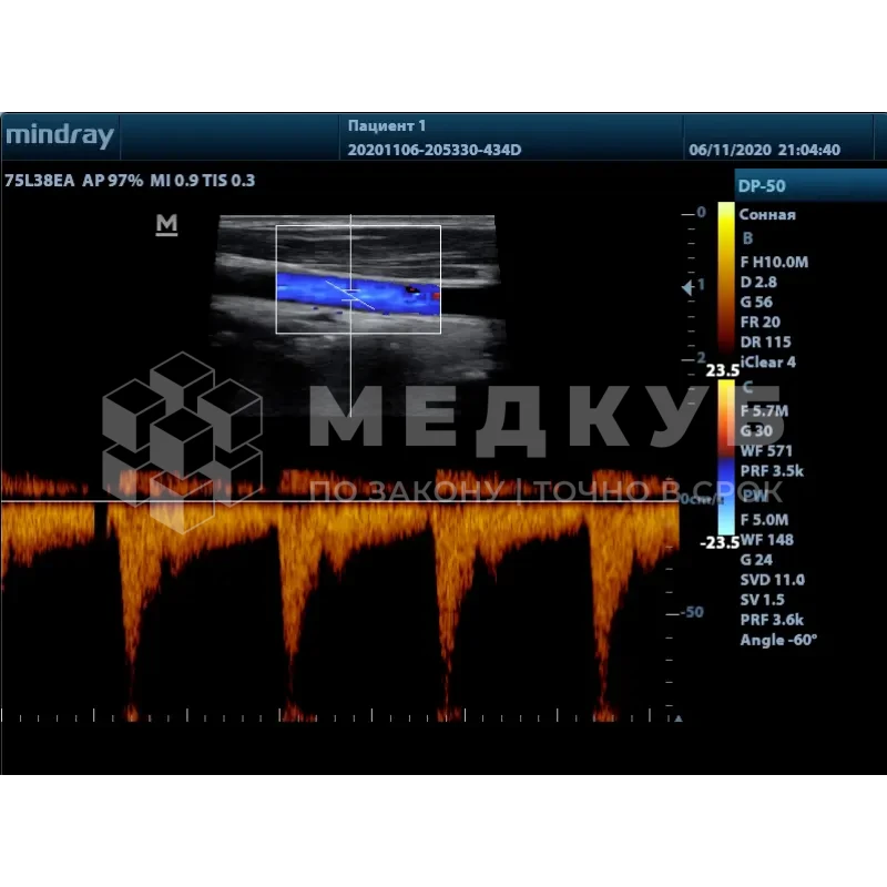 Аппарат УЗИ (сканер) Mindray DP-50 color